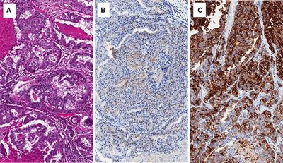 New Prostate Cancer Targets for Diagnosis, Imaging, and Therapy: Focus on Prostate-Specific Membrane Antigen